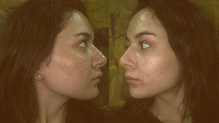 Nazish Jahangir, acne-shaming, moles